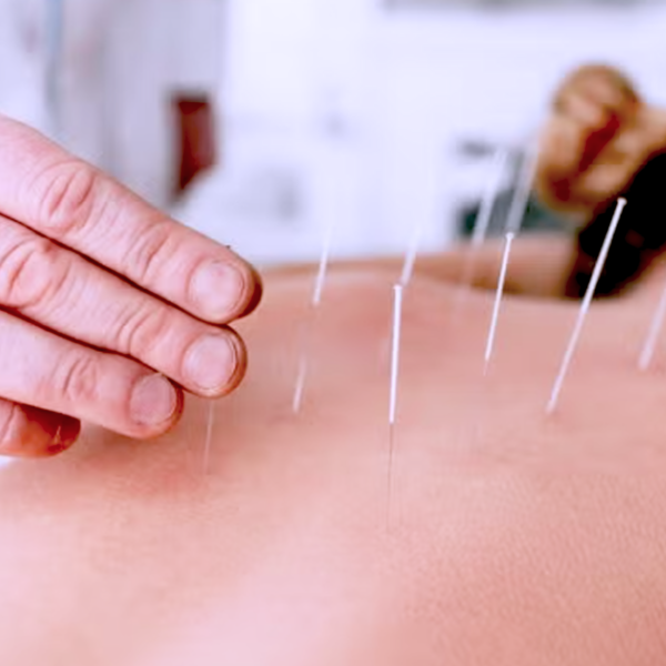 Acupuntura
